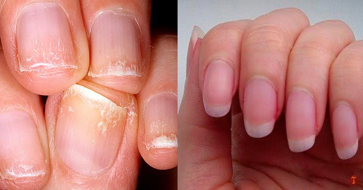 Как вылечить ногти после геля
